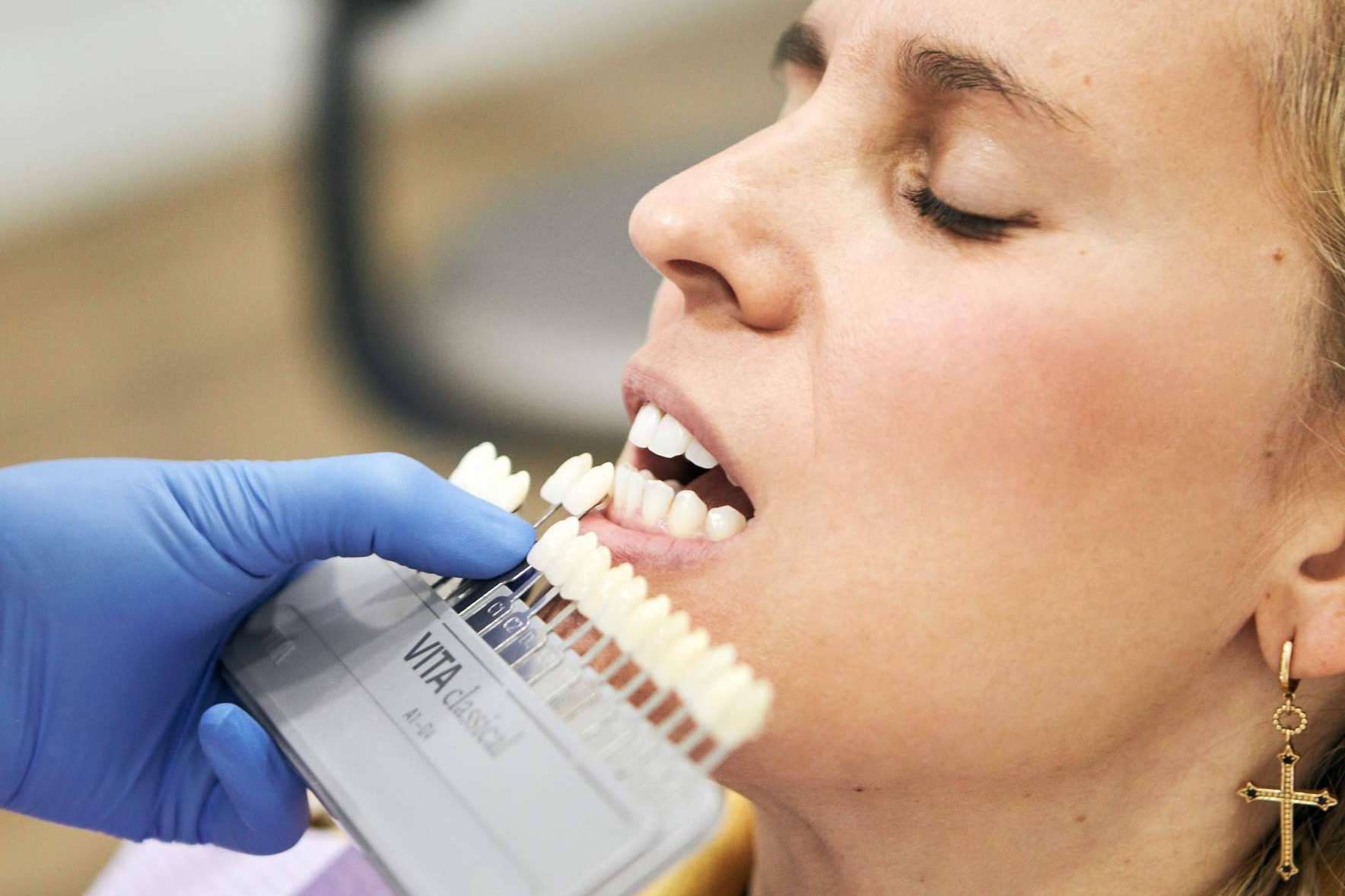 Rehabilitación estética con las carillas dentales de la Clínica Dental Dra. Irene Borro