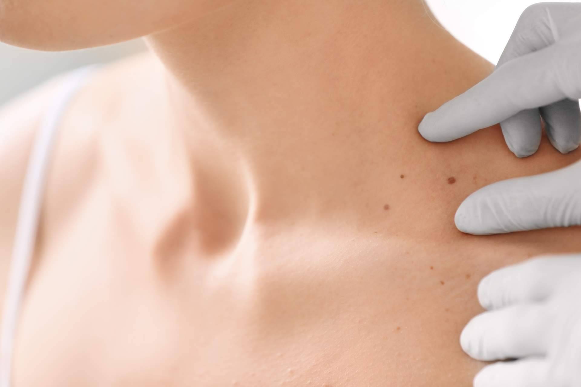Tratamientos para las manchas en la piel y cómo prevenir para el verano, por Farmacia Laura Garín