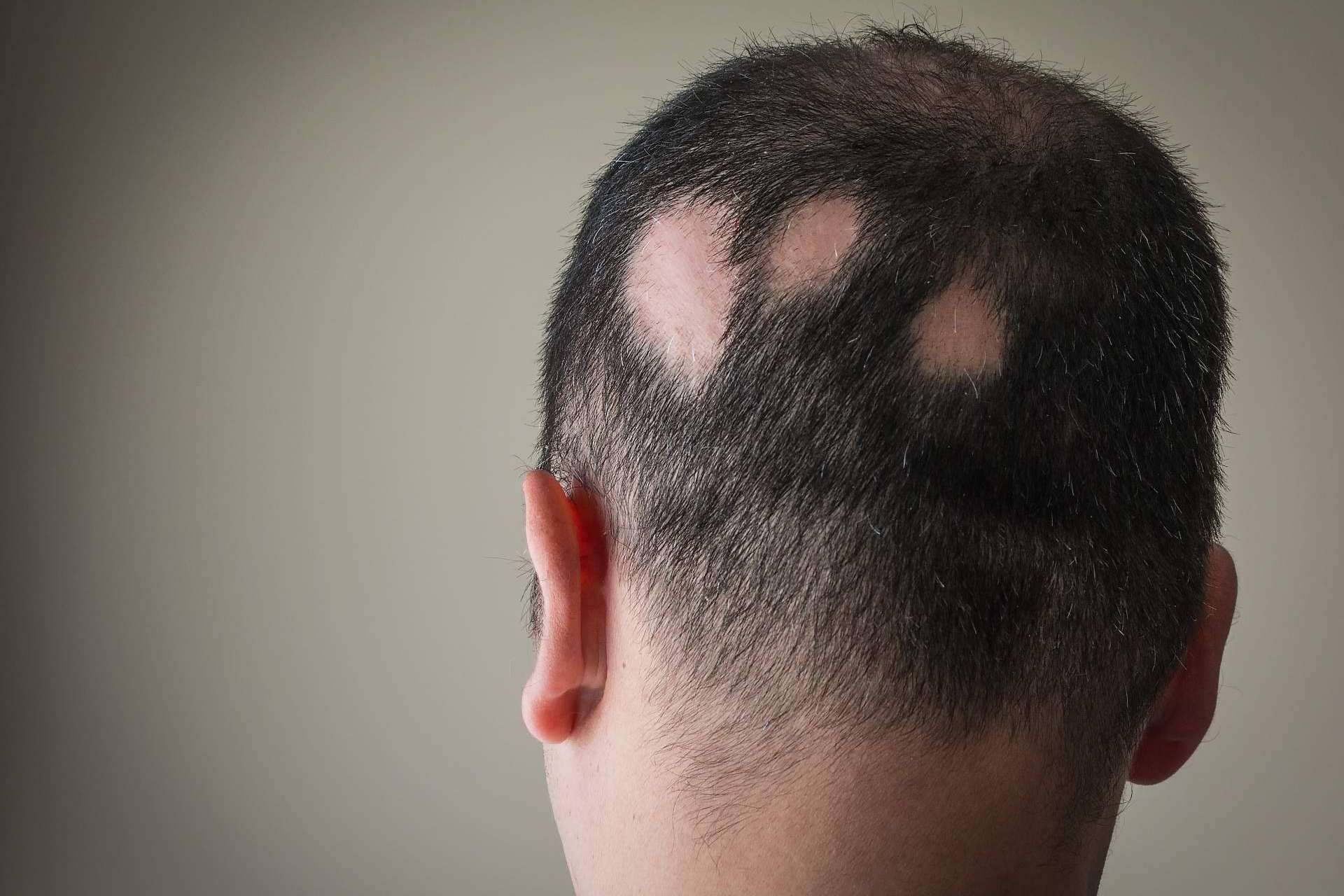 Combatir la alopecia areata con Saw Palmetto y su tratamiento