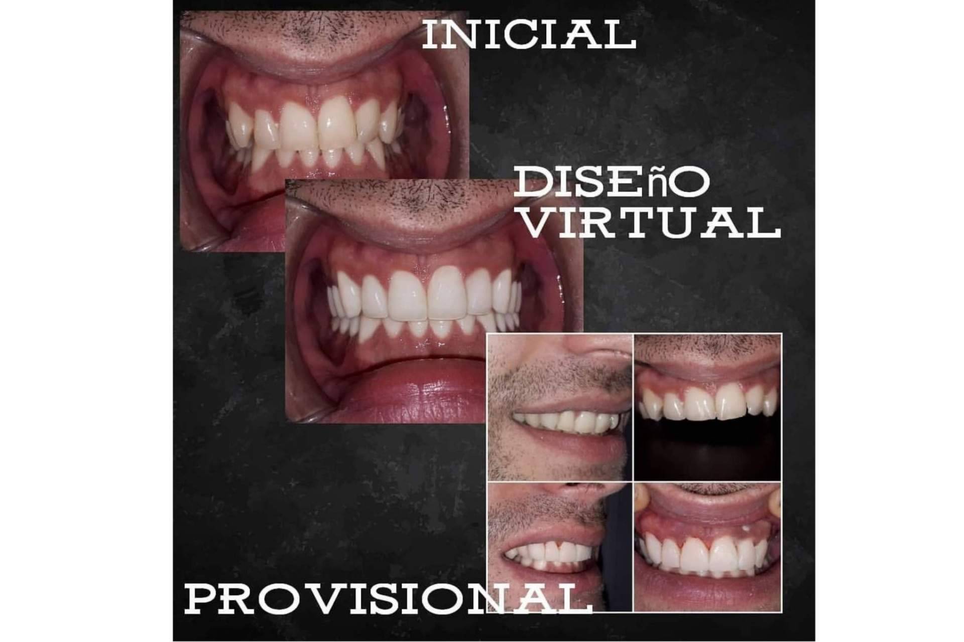 Tratamiento de alineación dentaria sin ortodoncia, por Dentinova