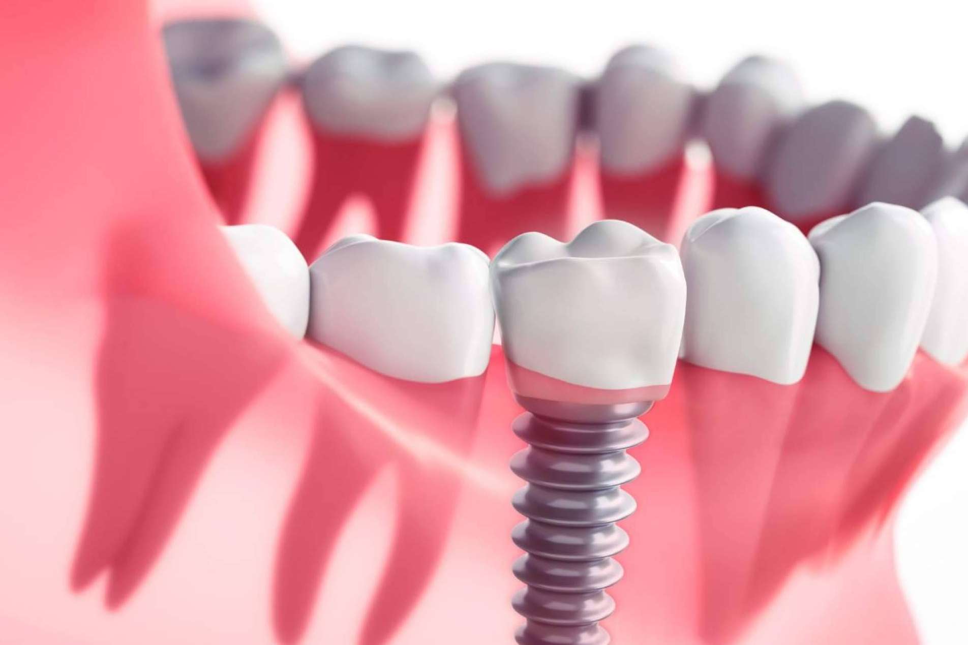 Los expertos de la Clínica Dental Crespí & Gandía ofrecen técnicas de rehabilitación oral para cada caso