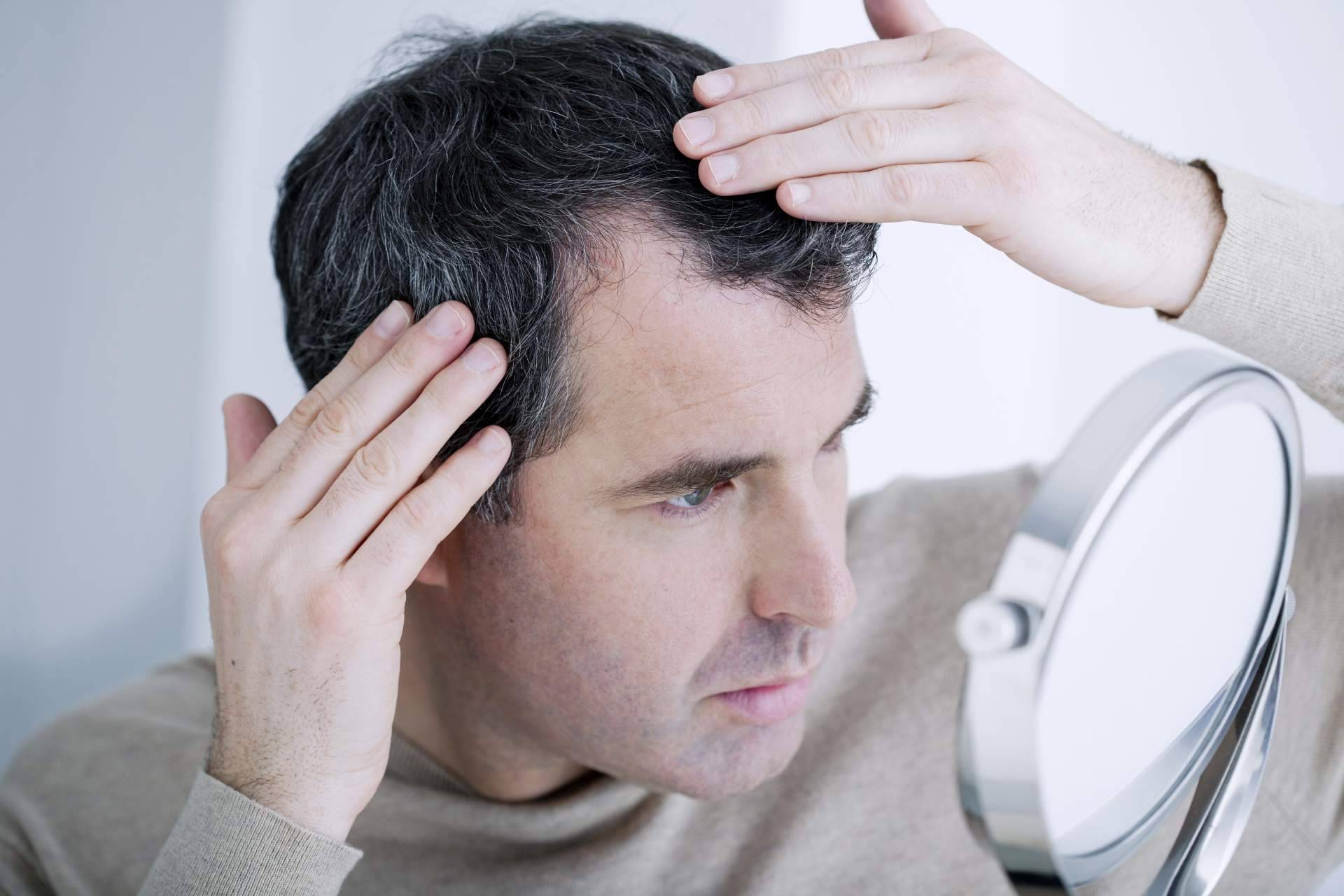 ¿Por qué el trasplante de pelo en la coronilla es la solución definitiva para la alopecia en esta zona?