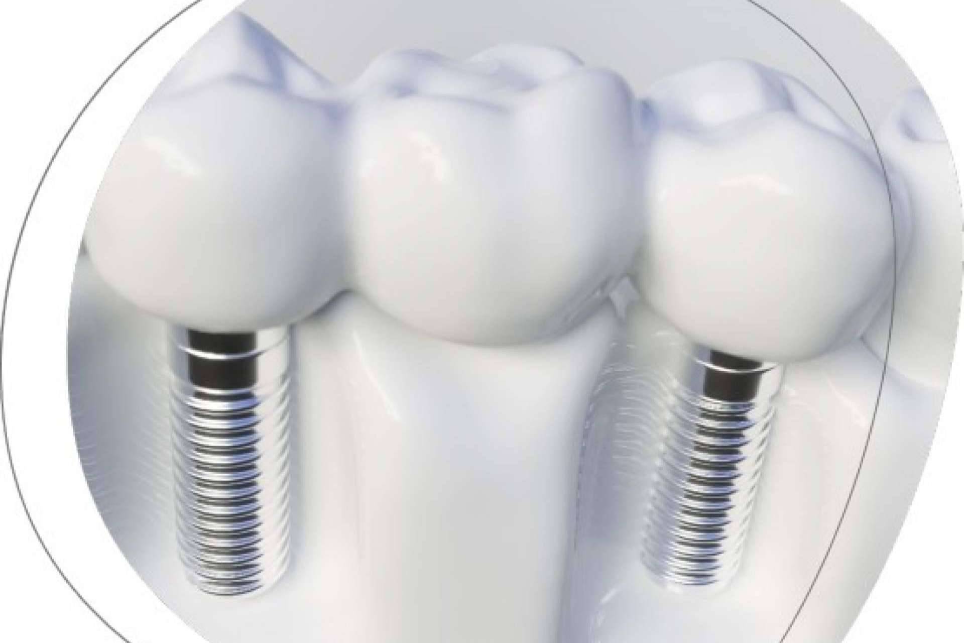 Clínica Dental Agudo Rosa de Albacete, expertos en implantes dentales
