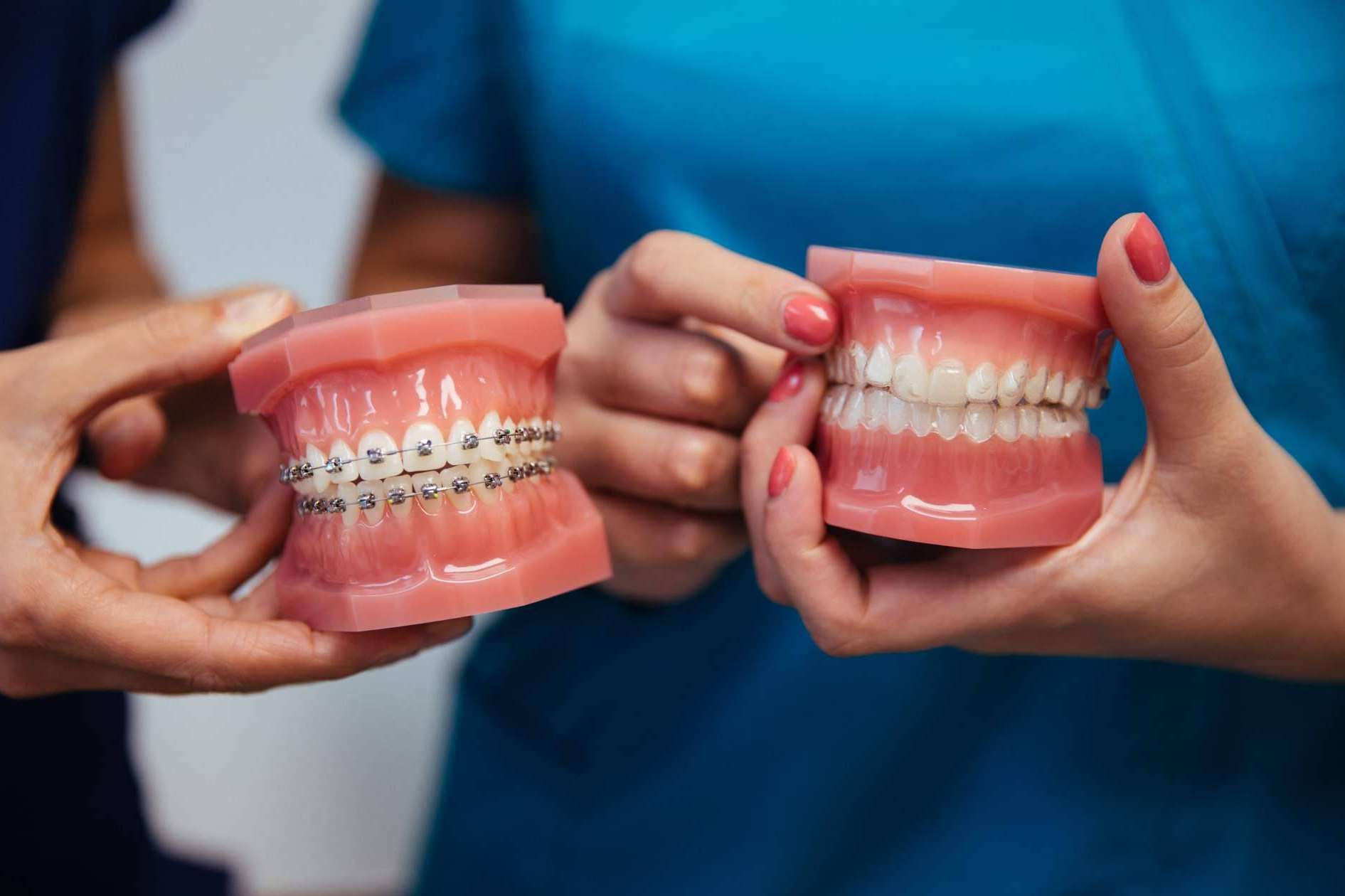 5 ventajas de la ortodoncia invisible Invisalign frente a los brackets, por Dientes Redondos