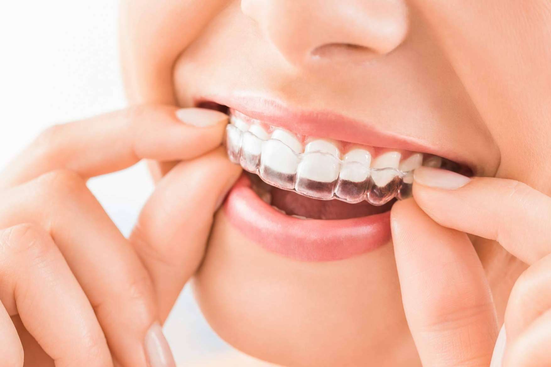 Clínicas Dental Bell, en Sevilla, ayudan a corregir la sonrisa de forma estética con Invisalign