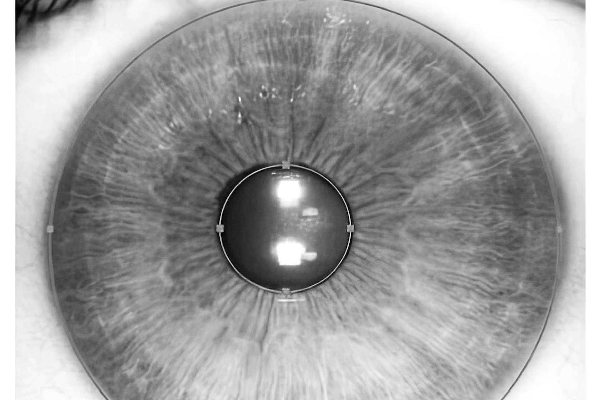 ¿Cuáles son las ventajas de la tecnología láser para cambiar el color de ojos?
