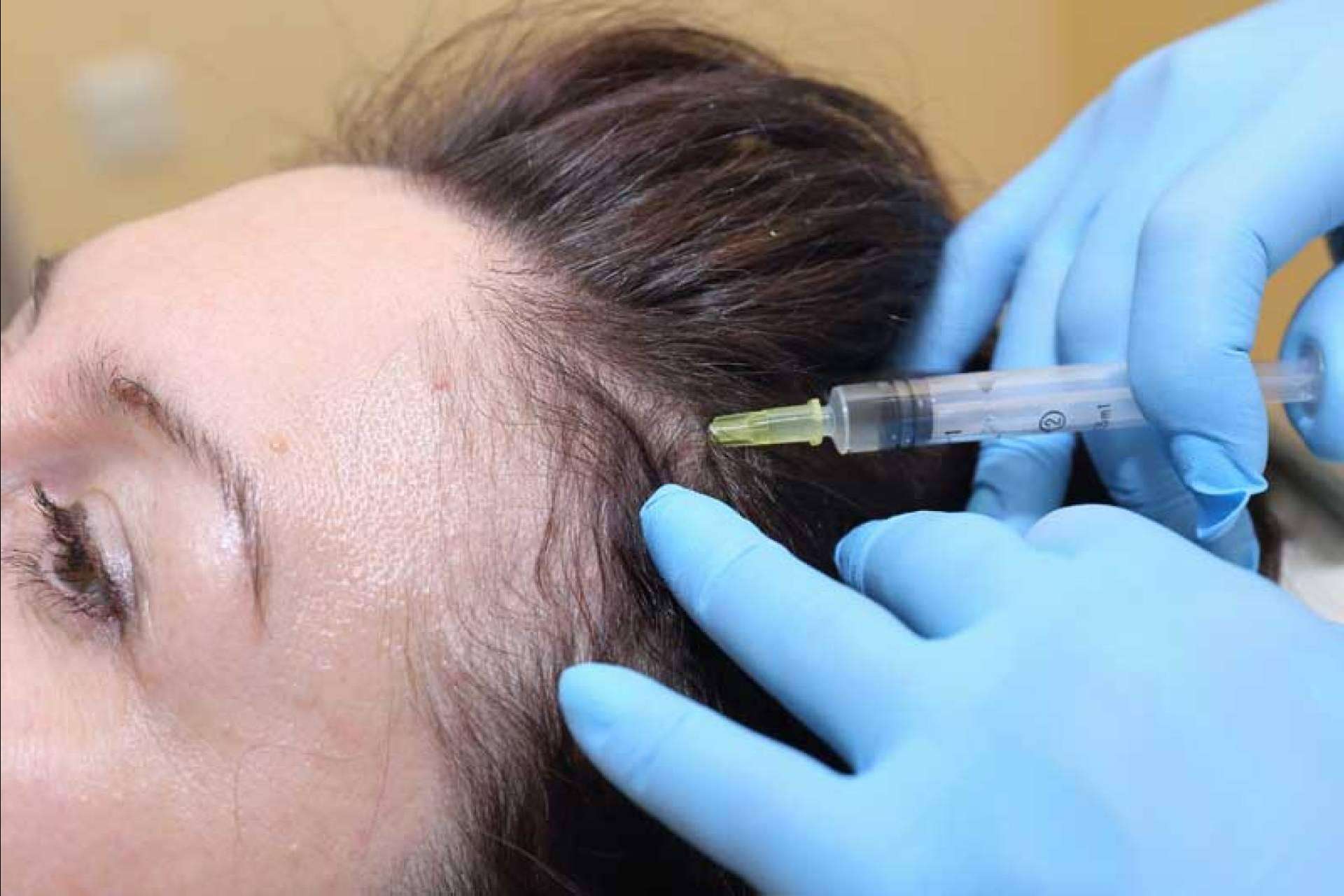 Ventajas de realizarse un tratamiento de mesoterapia capilar de IMD para recuperar las condiciones óptimas del cabello
