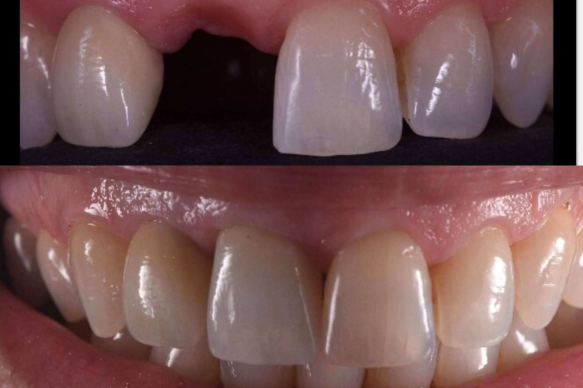 Todo sobre los implantes dentales de la Clínica Calvo de Mora