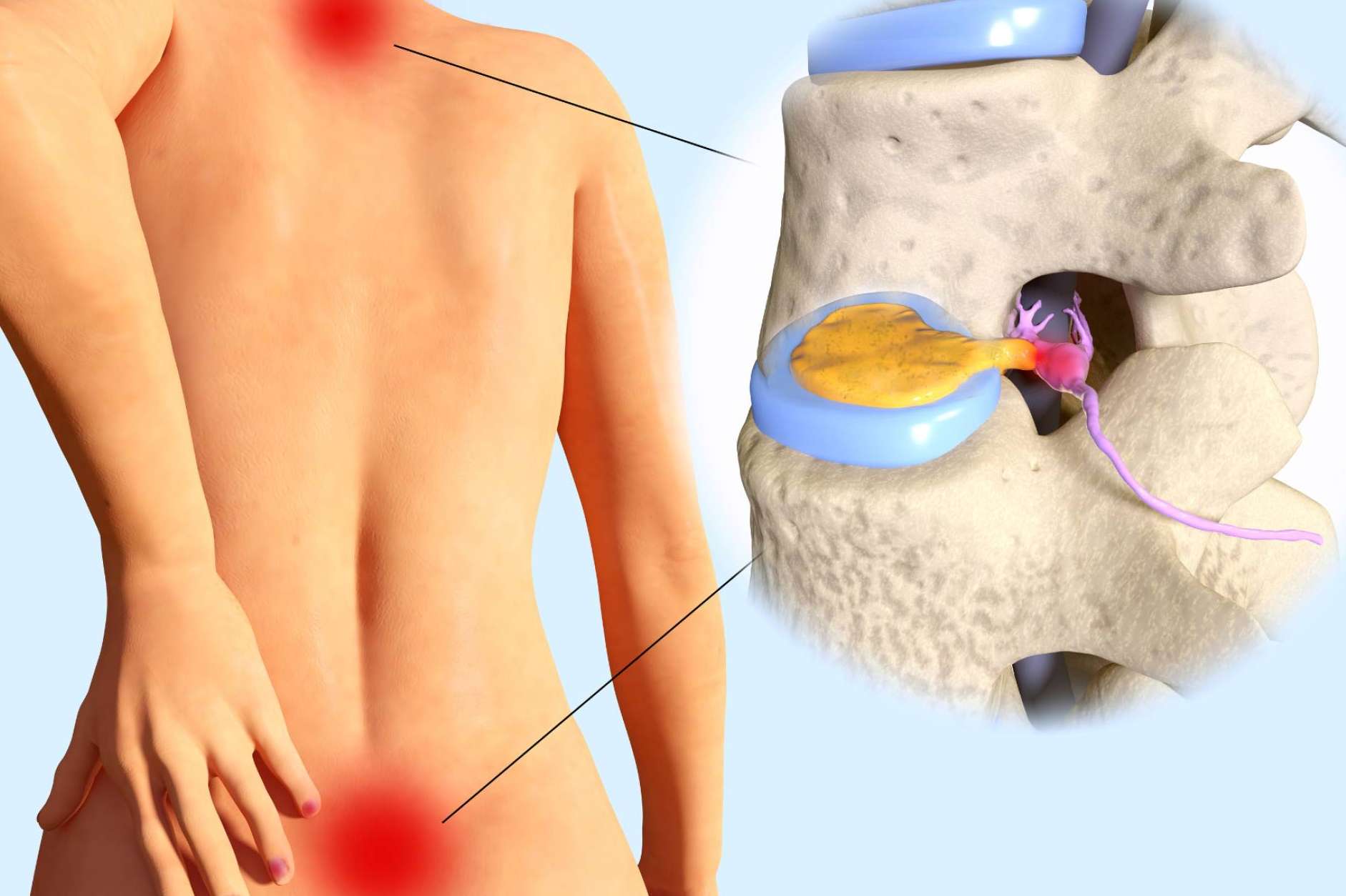 Hernia discal y andulación, un enfoque terapéutico innovador