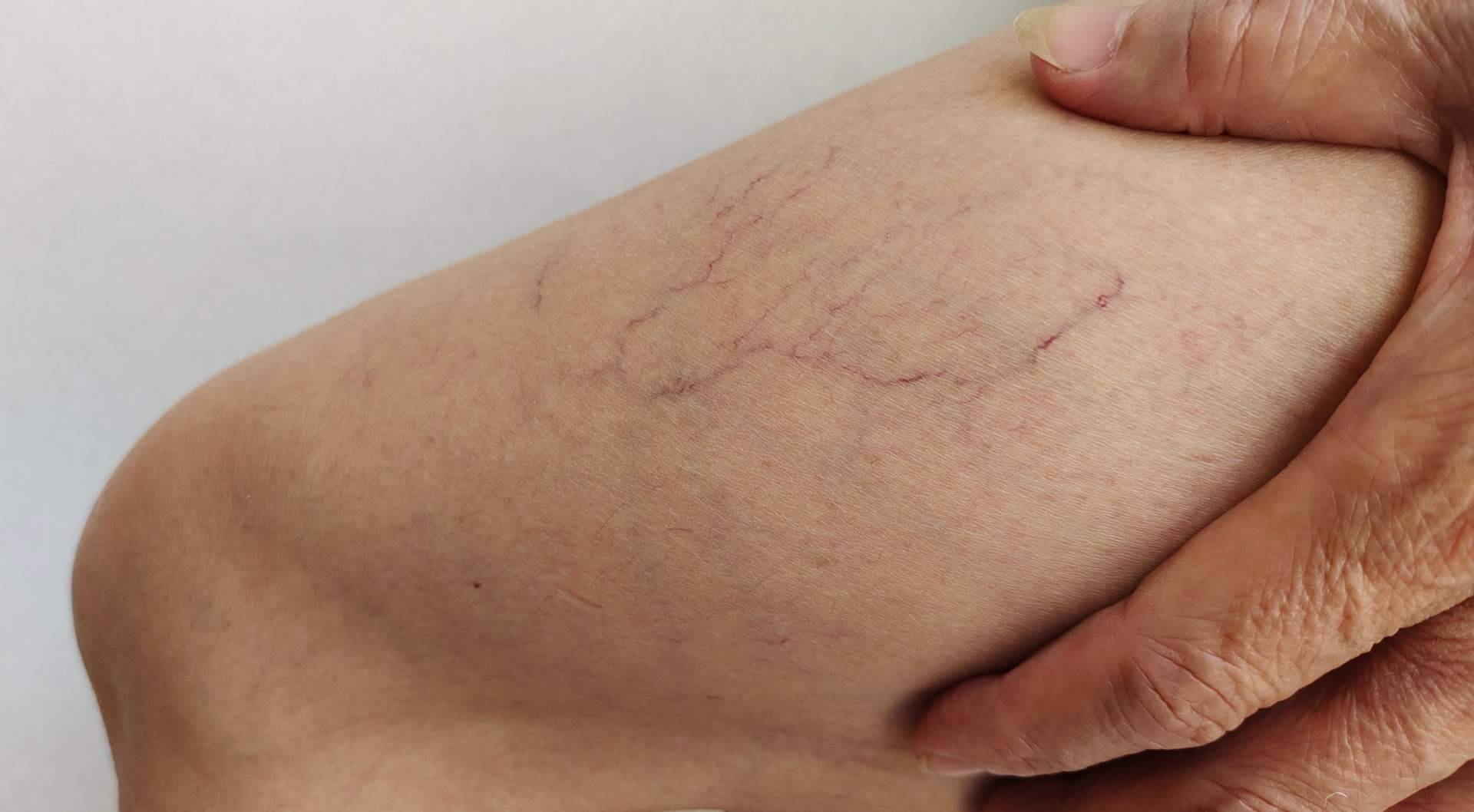 La mala circulación provoca pesadez de piernas e hinchazón en verano