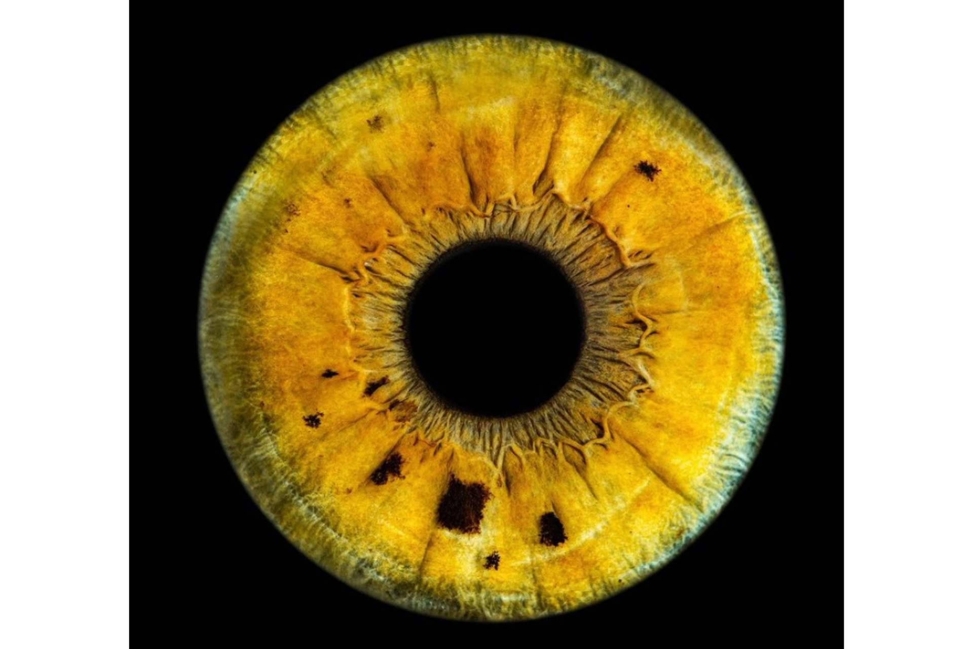 ¿Qué celebridades tienen una heterocromía ocular?, por Clínica Eyecos