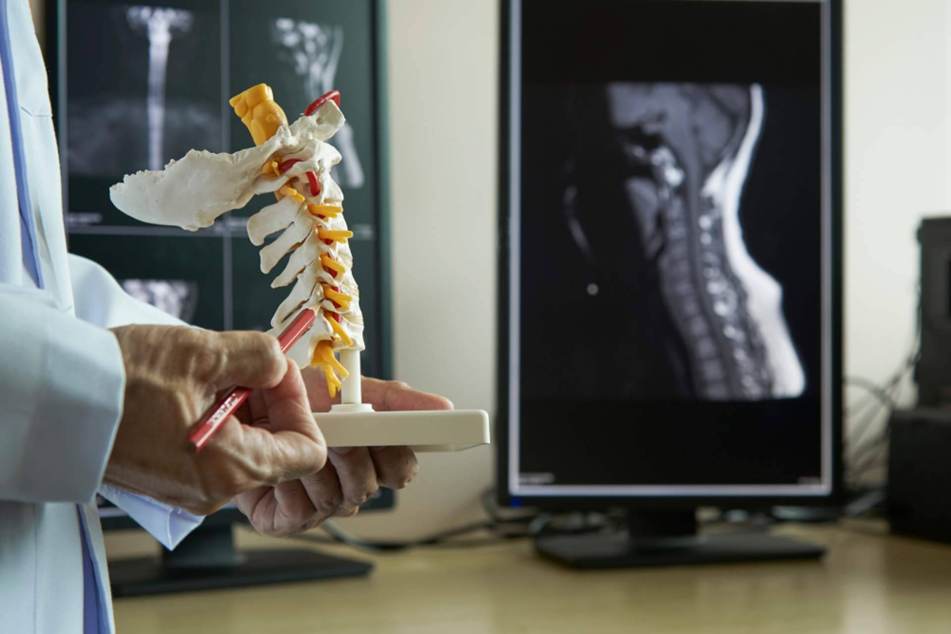iXalud explica las causas de la espondilolistesis