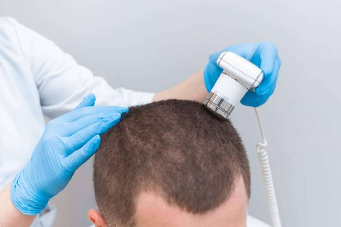 ¿Cómo son los tratamientos de mesoterapia capilar Madrid con Capilar Innovation Clinic de parte Doctor Jesus Mora?