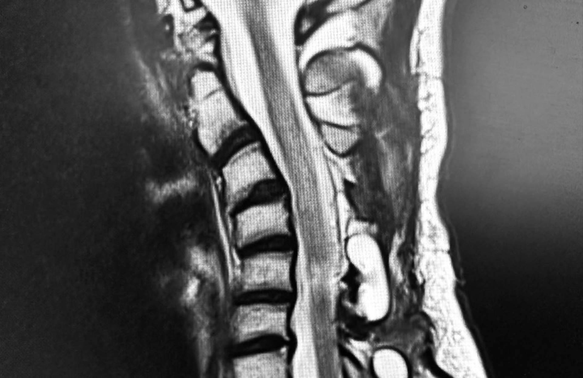 El Dr. Botella-Asunción habla de la cifosis post-laminectomía cervical