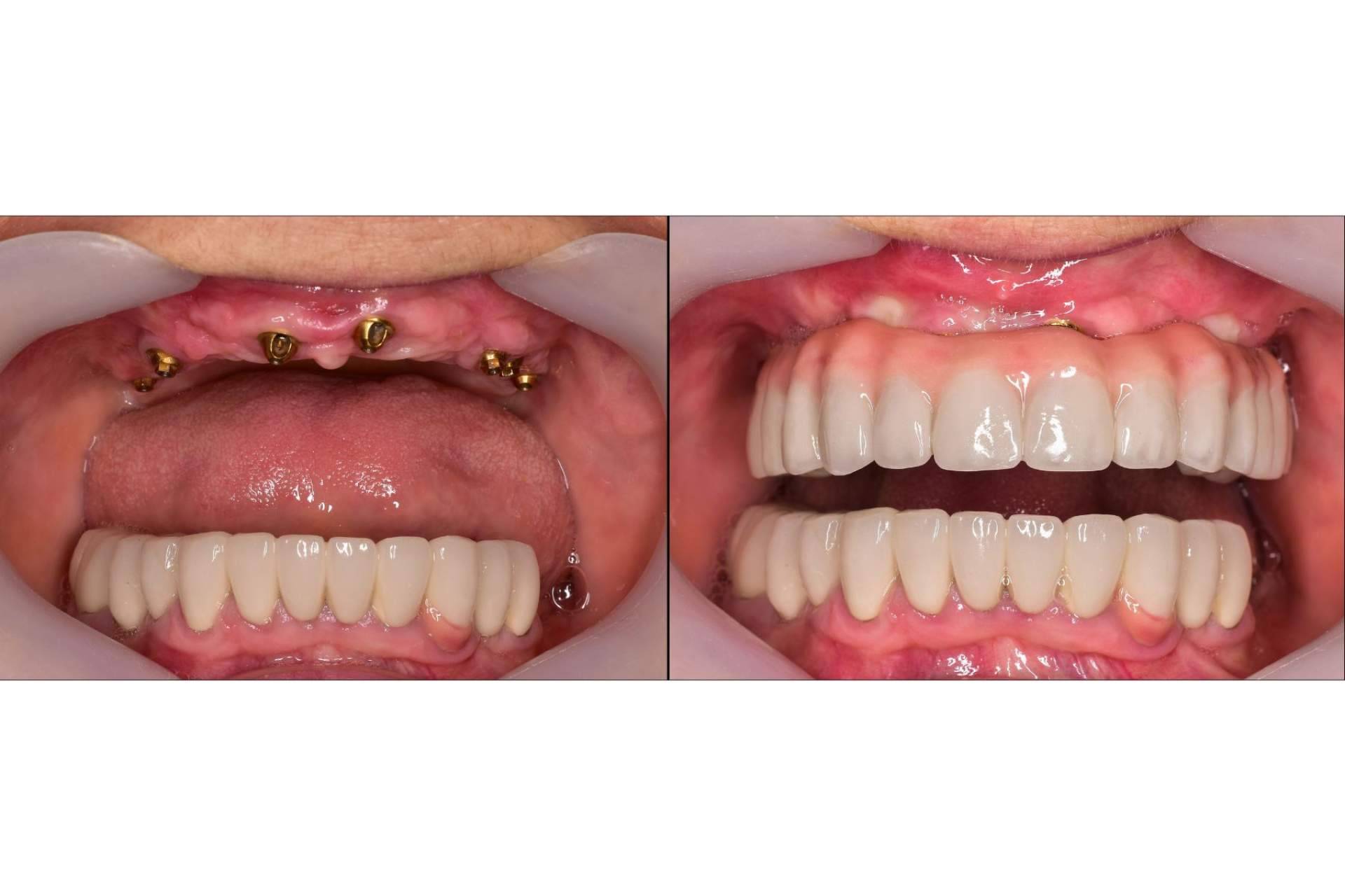 Los beneficios de un implante dental en DeltaDent