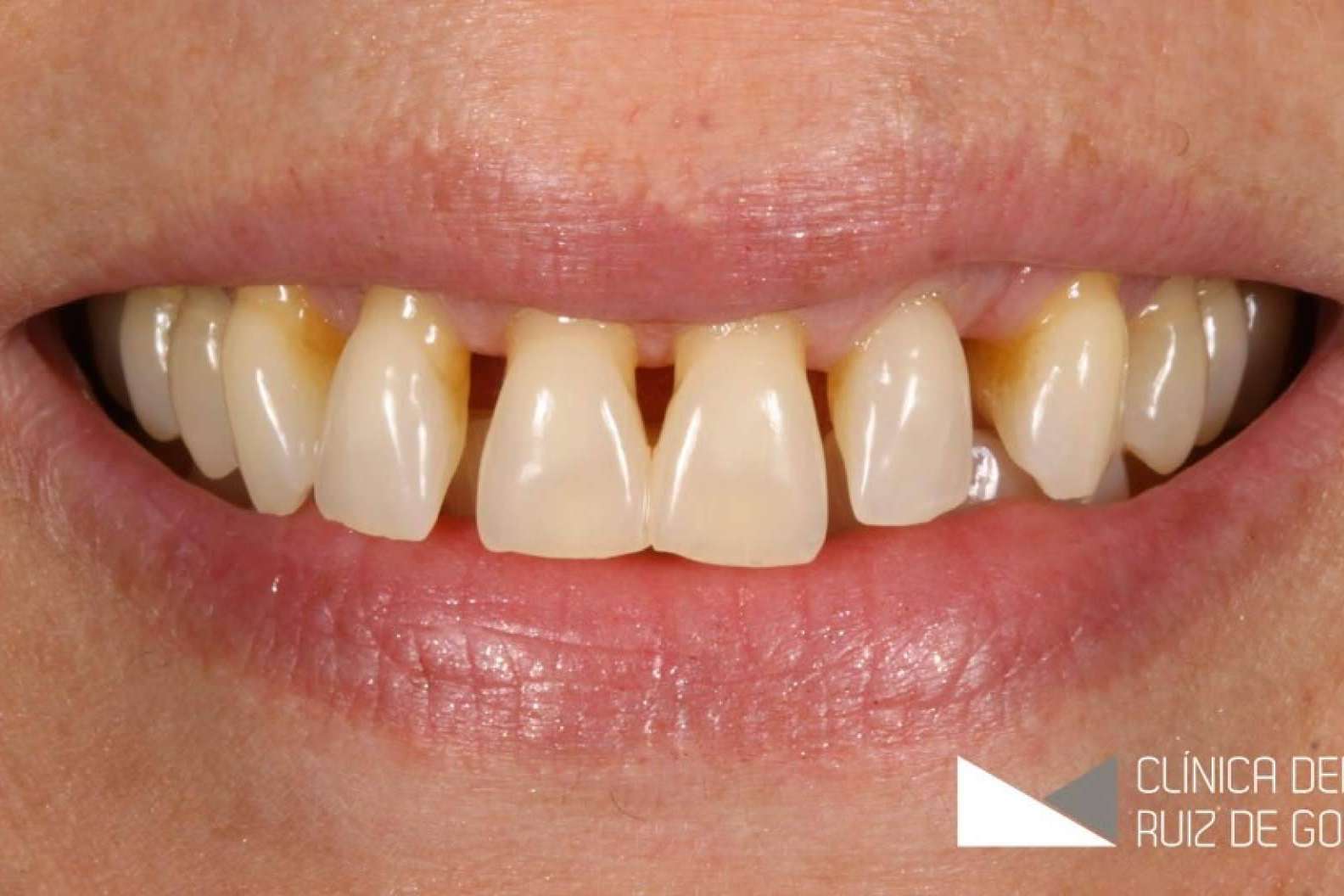 La innovadora técnica de injerto de encías restaura la salud y estética dental con precisión