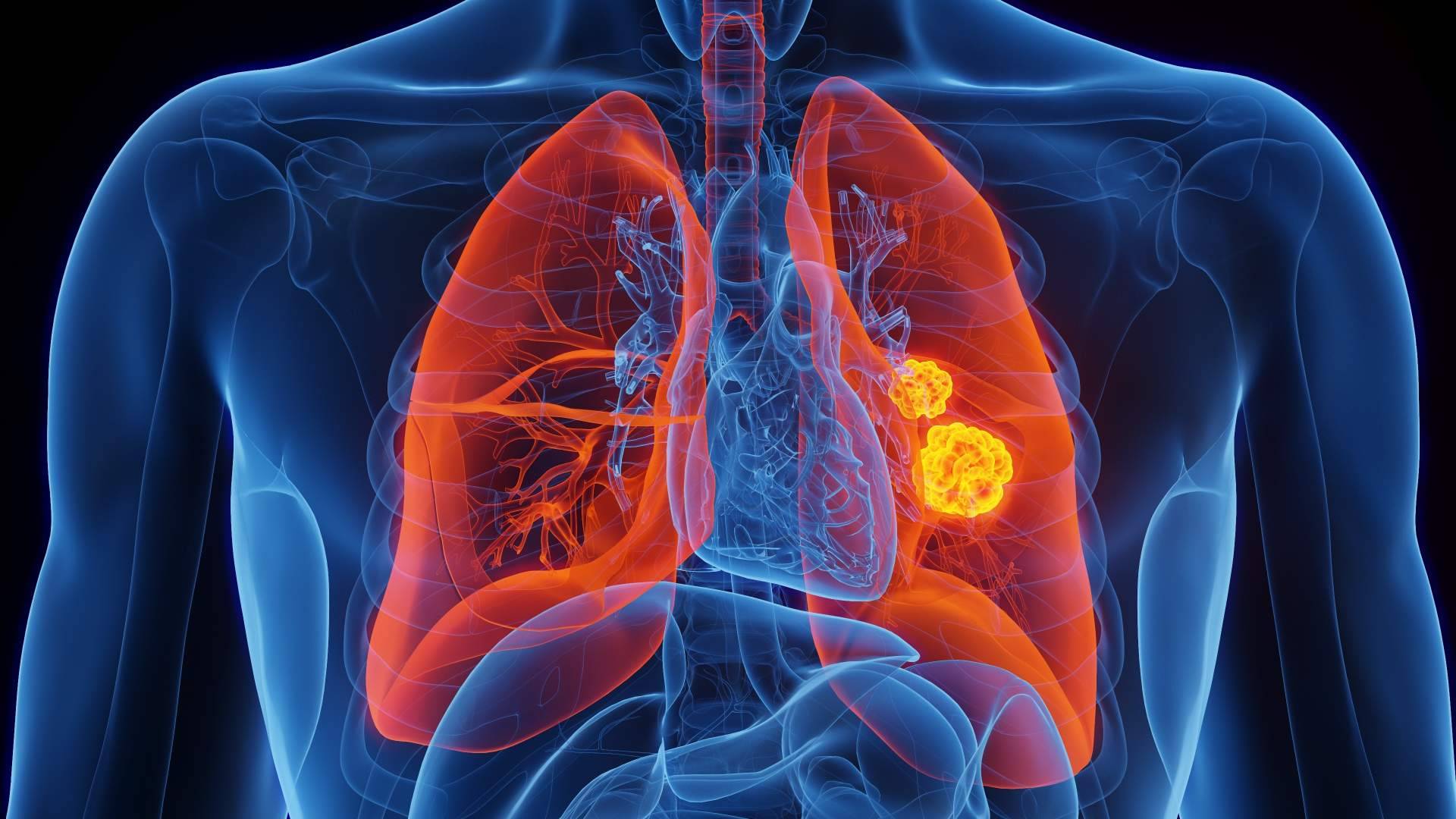 El tratamiento de cáncer de pulmón con Oncothermia (Nanothermia)