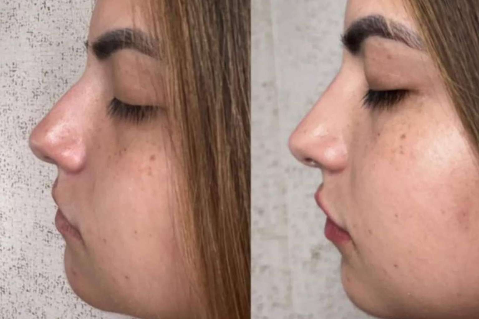 La clínica del Dr. Guidi tiene especialistas en rinomodelación en Málaga