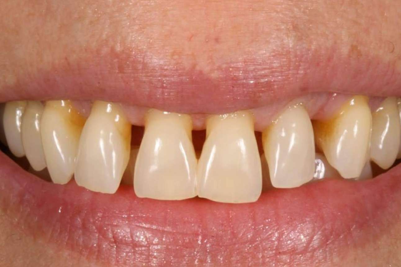 ¿Cómo prevenir y tratar las enfermedades periodontales?