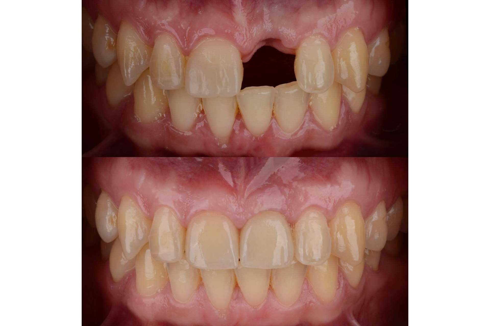 Los beneficios de los implantes dentales, por DeltaDent