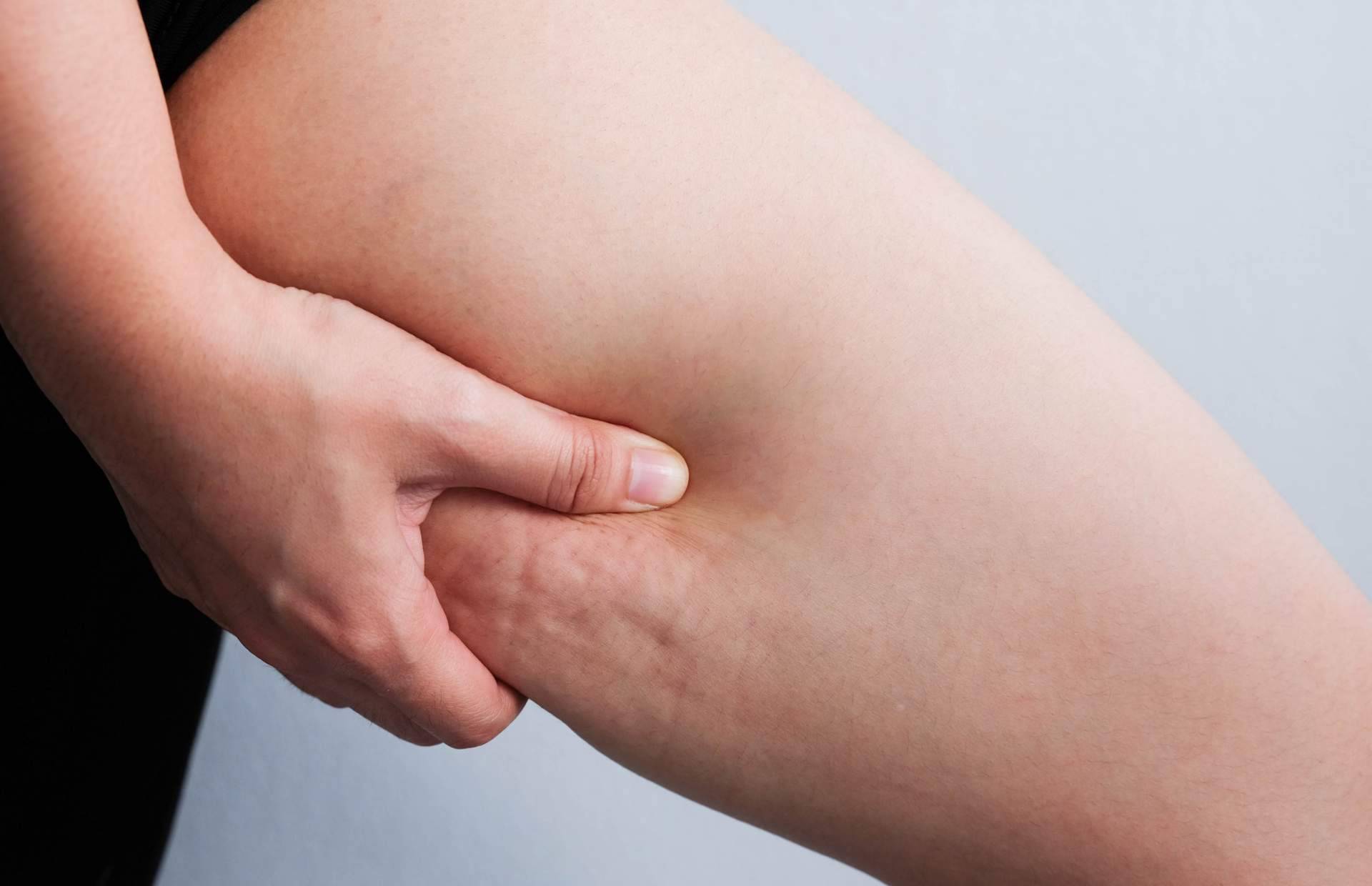 Cuerpo Libre y sus tratamientos anticelulíticos saludables