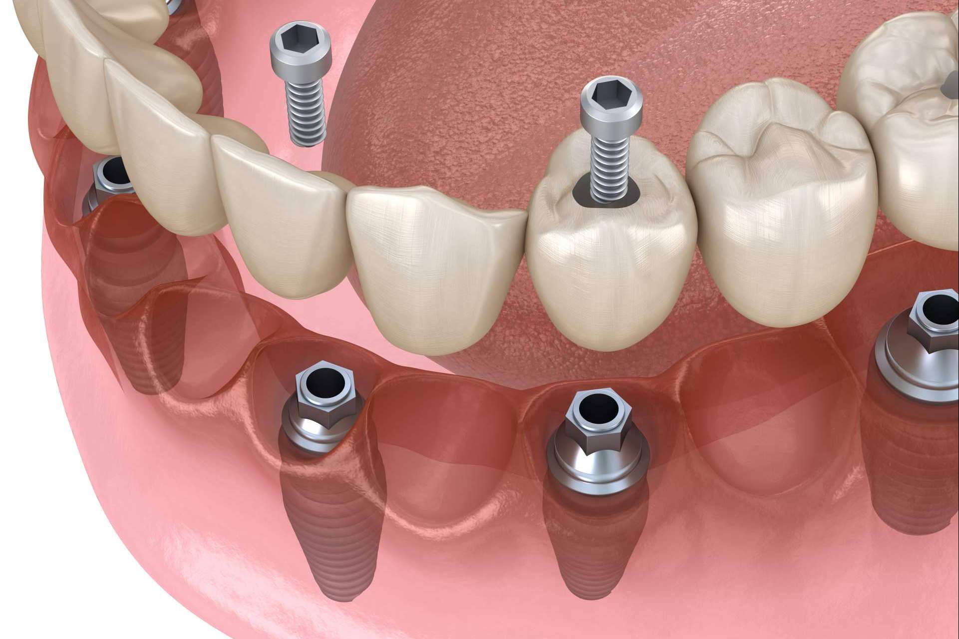 Los implantes dentales inmediatos de DeltaDent permiten recuperar la mejor versión de la sonrisa