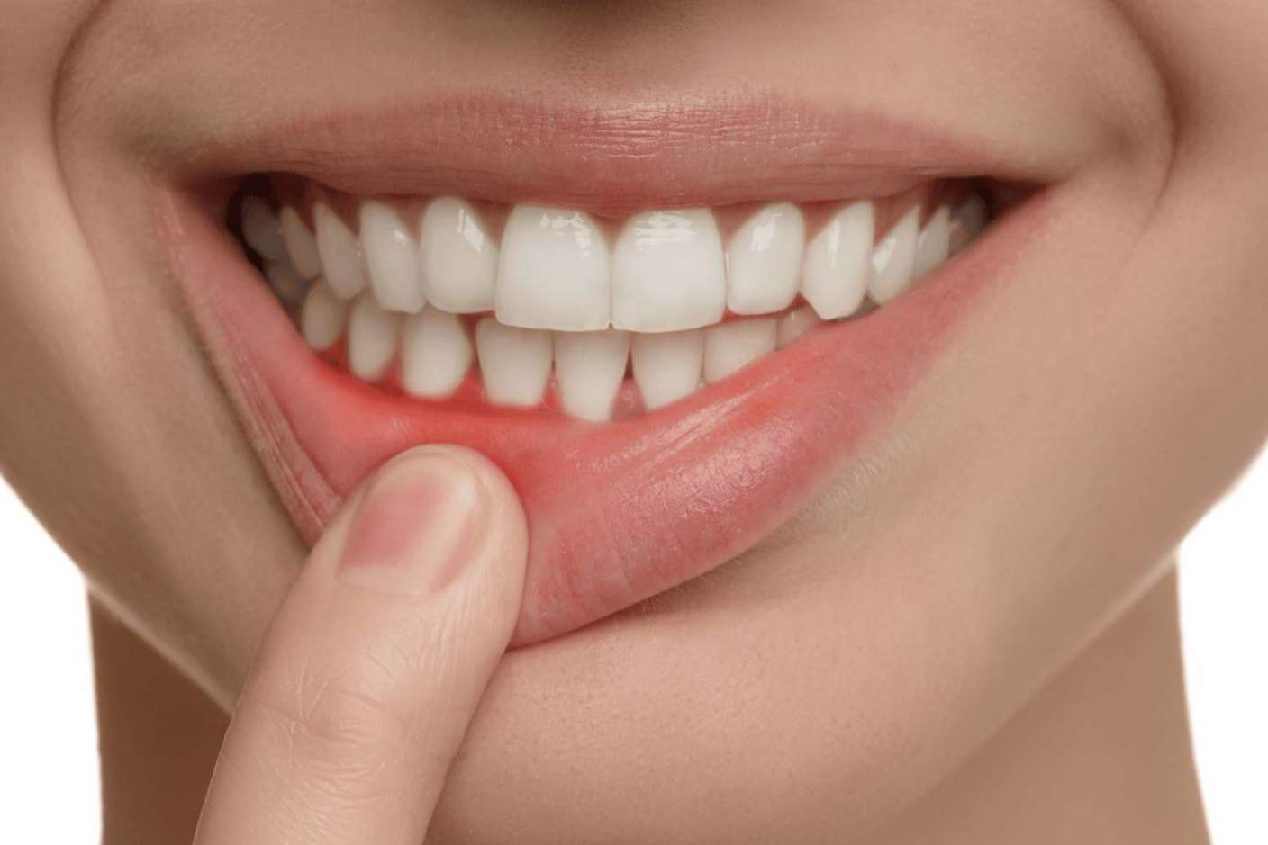 Tratamiento para la gingivitis, de la mano de Clínica Dental Ruiz de Gopegui