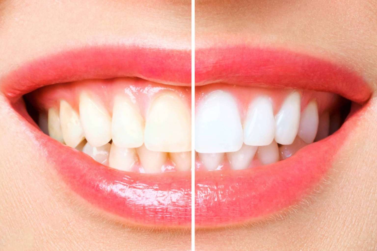Lograr una apariencia radiante de la dentadura gracias al blanqueamiento dental avanzado con luz LED