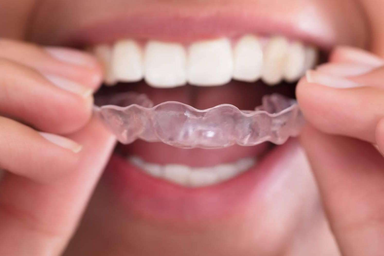Los expertos de Lola Escalante Estudio Dental hablan sobre los beneficios de la Ortodoncia Invisible Fast
