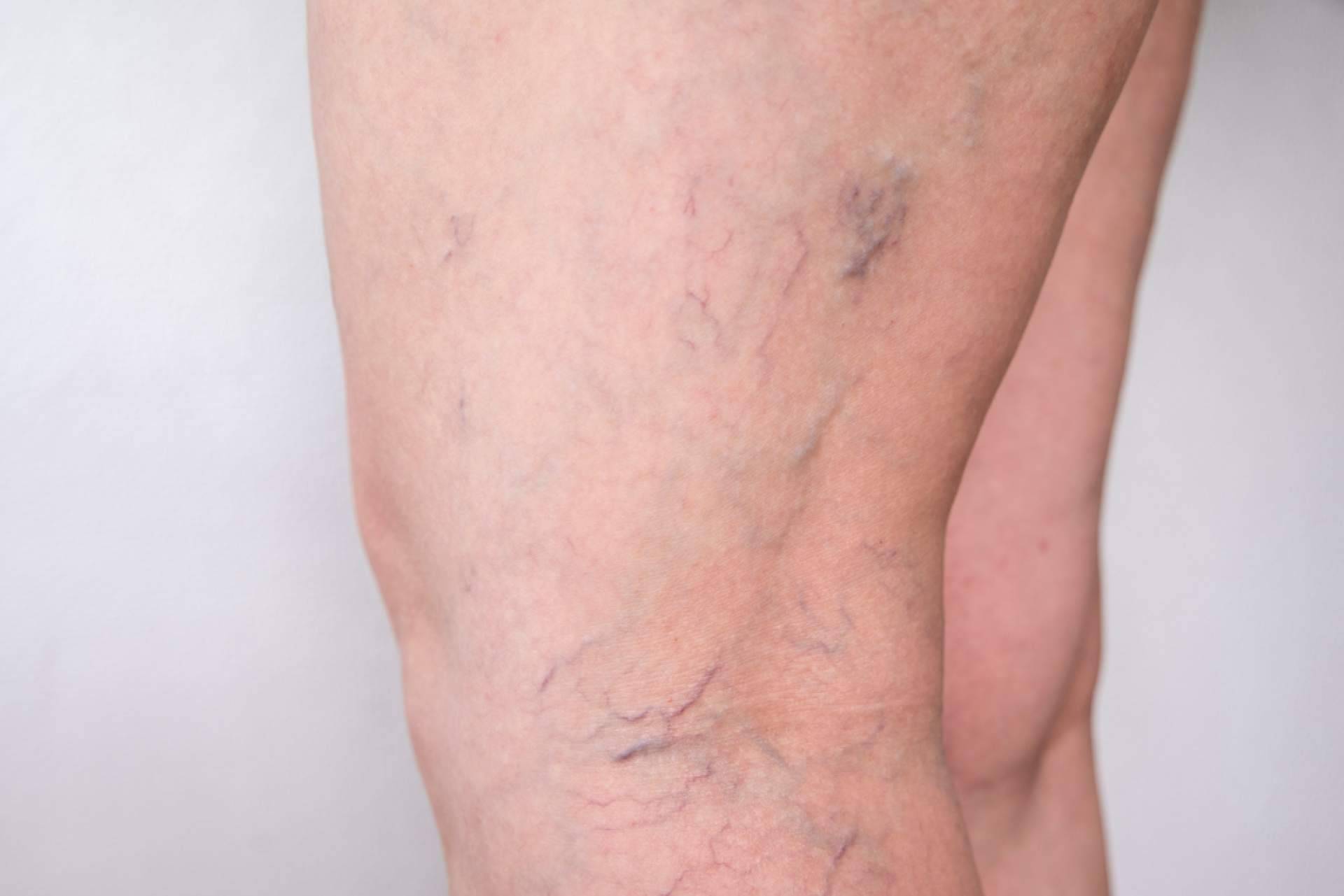 Elegansse, especialistas en la eliminación de varices