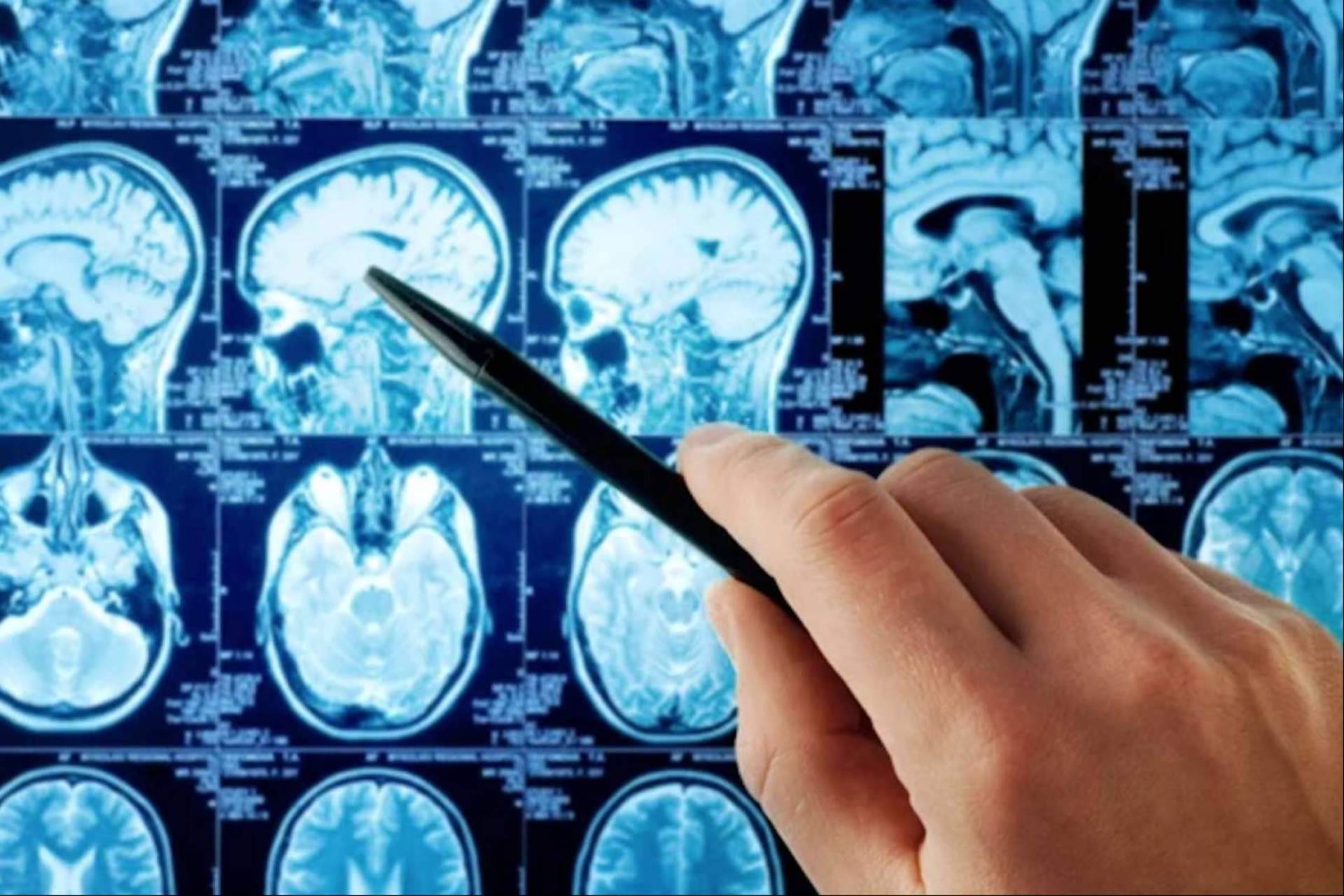¿Cuáles son los beneficios de oncothermia en tumor cerebral (Gliomas)?
