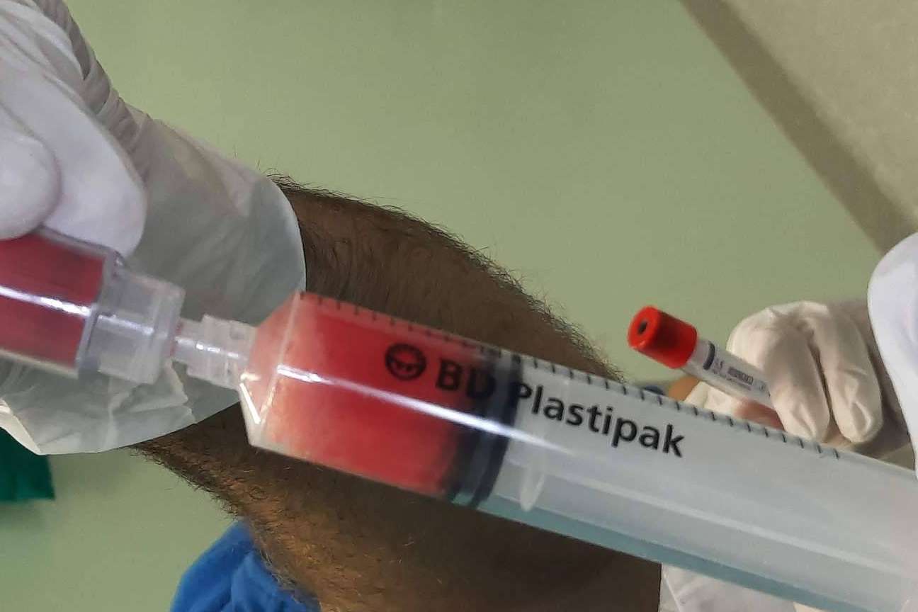 Infiltraciones de plasma rico en plaquetas y células madre, un tratamiento eficaz sin cirugía para artrosis de rodilla