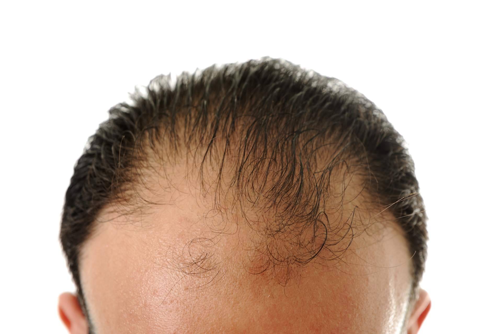 Xpecia Tablet, el tratamiento revolucionario para la alopecia androgénica que llega a España de la mano de Saw Palmetto
