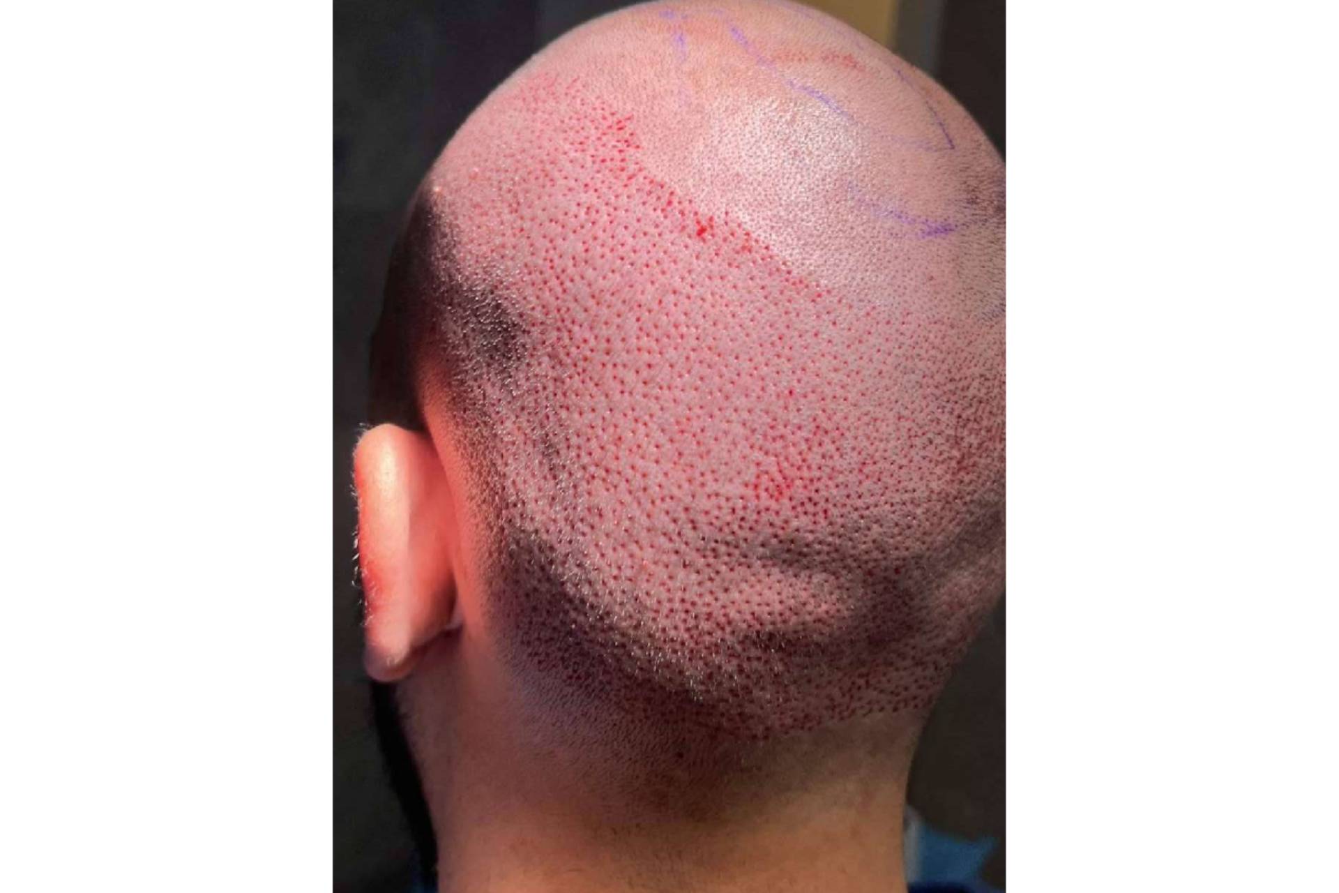 El Dr. Chara, un especialista en injerto capilar en Barcelona  y otros tratamientos para la alopecia