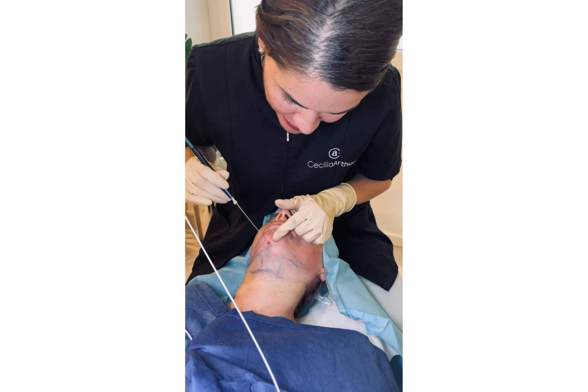 Reducir papada con Klaser Blue, con la Dra. Cecilia Arthur