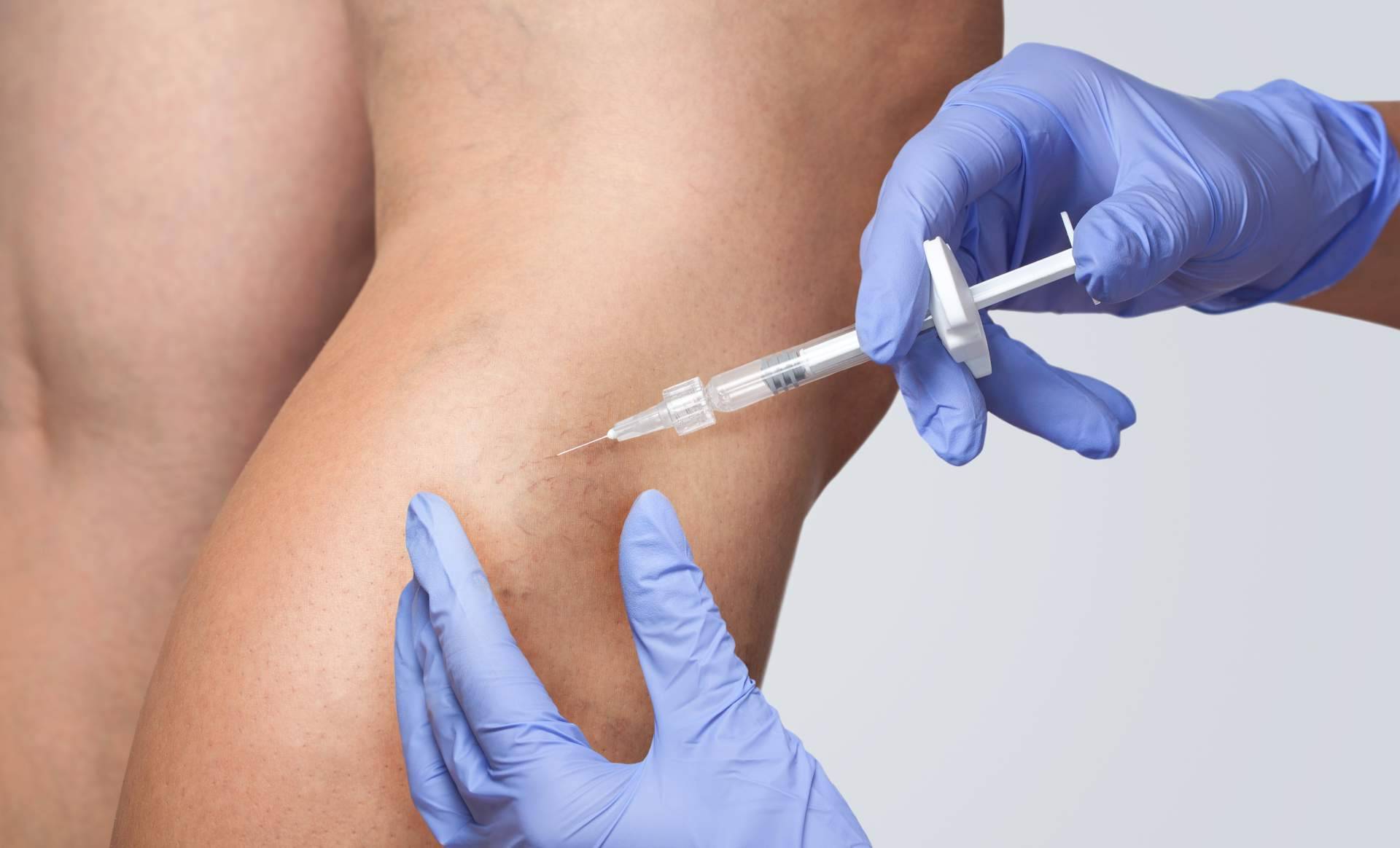 Las ventajas de eliminar las varices además del aspecto estético