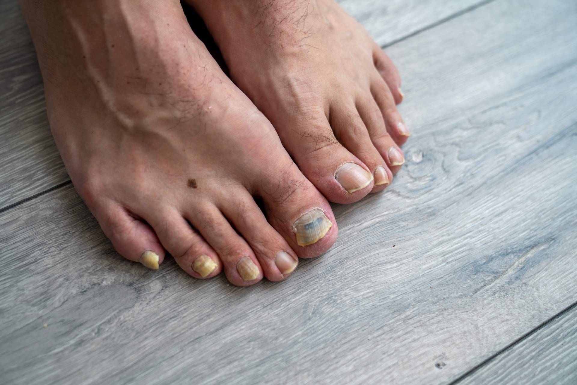 Consejos para prevenir las infecciones por hongos en verano, por Laboratoires Bailleul