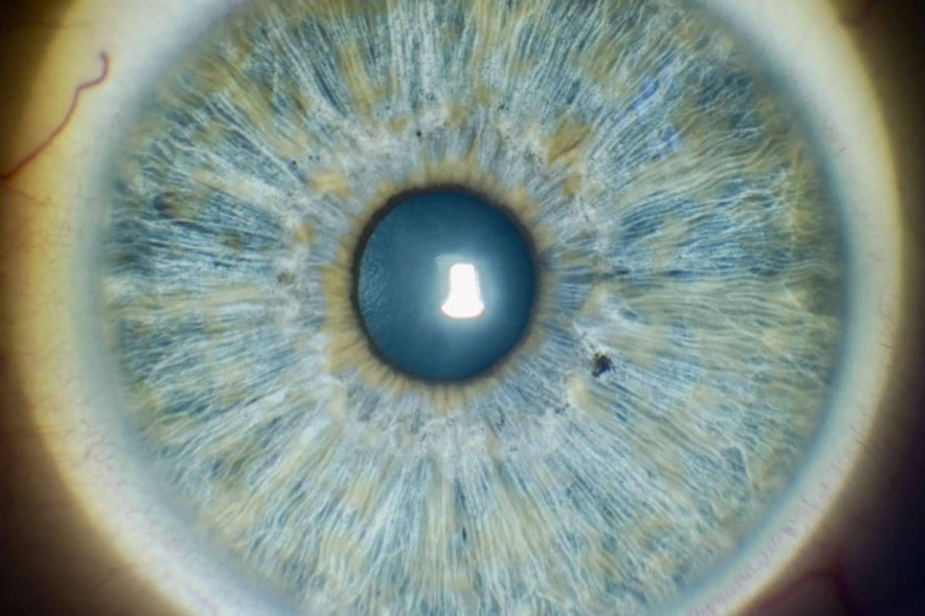 Iridoplastia láser, avanzada tecnología para cambiar el color de los ojos con los expertos de la Clínica Eyecos