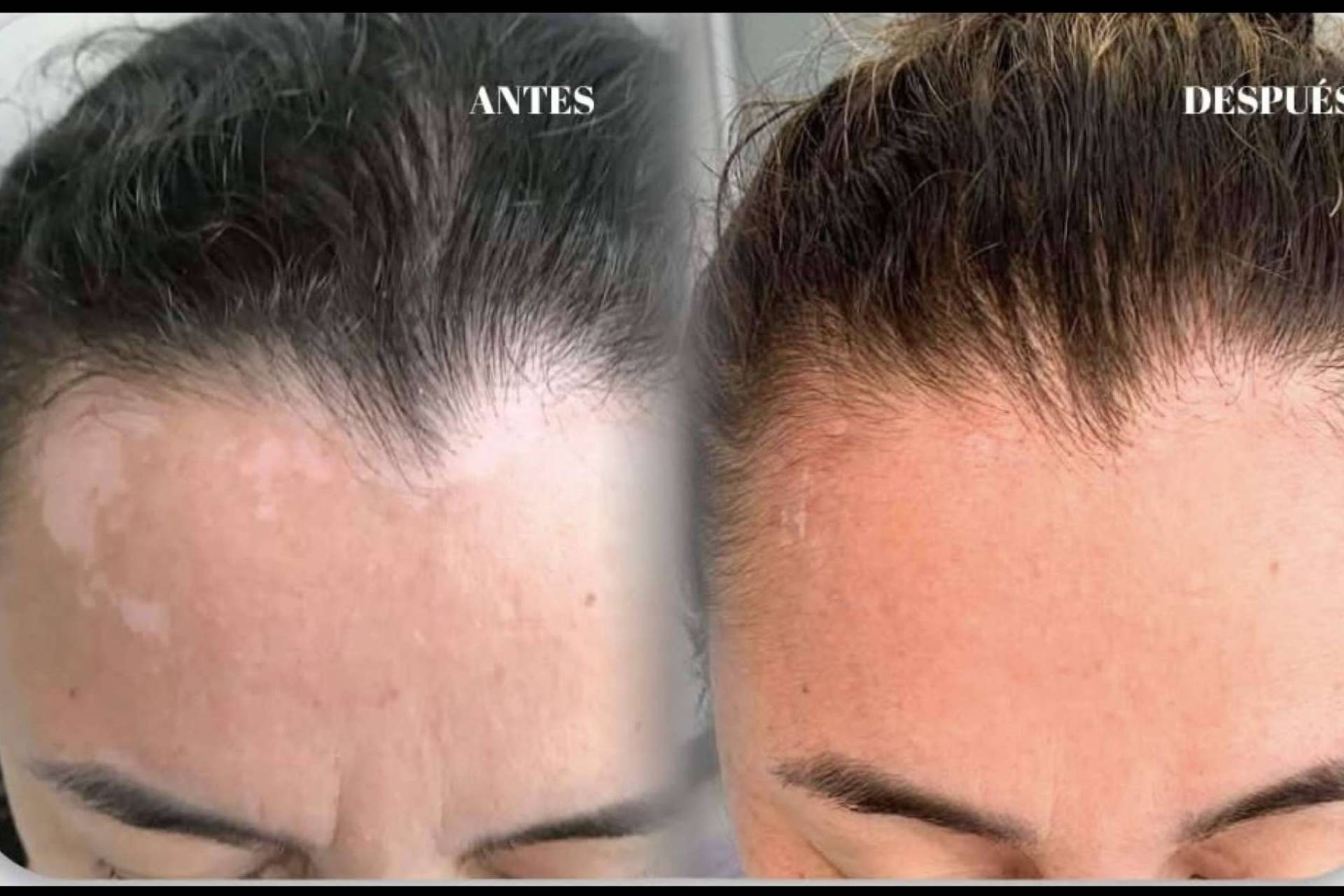 La Dra. Janeth Arévalo implementa terapia combinada para el tratamiento del vitiligo en Clínica God Bless en Loja