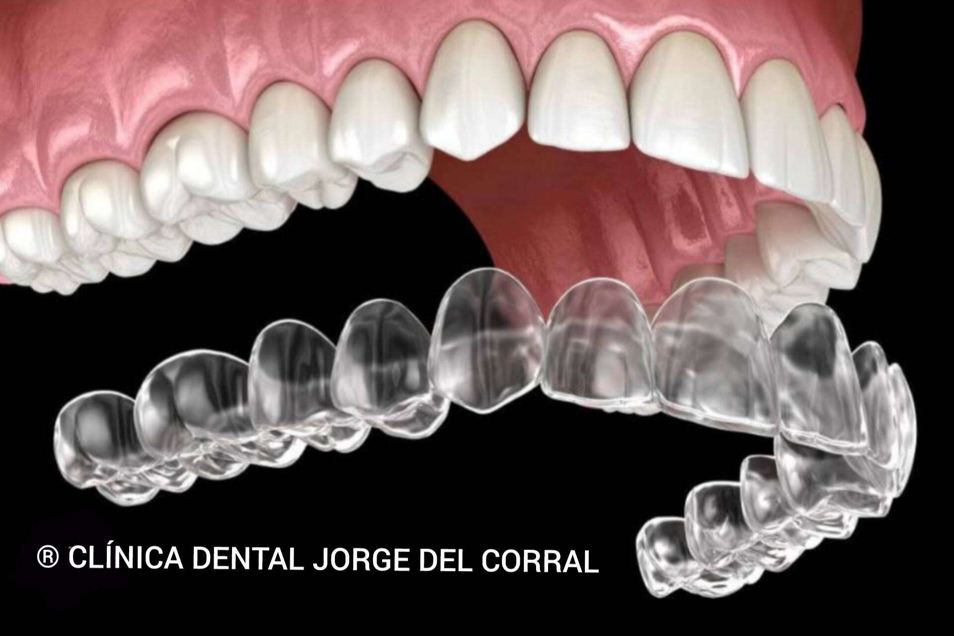Clínica Dental Jorge del Corral posiciona la ortodoncia invisible como tratamiento clave en su clínica dental en Hortaleza