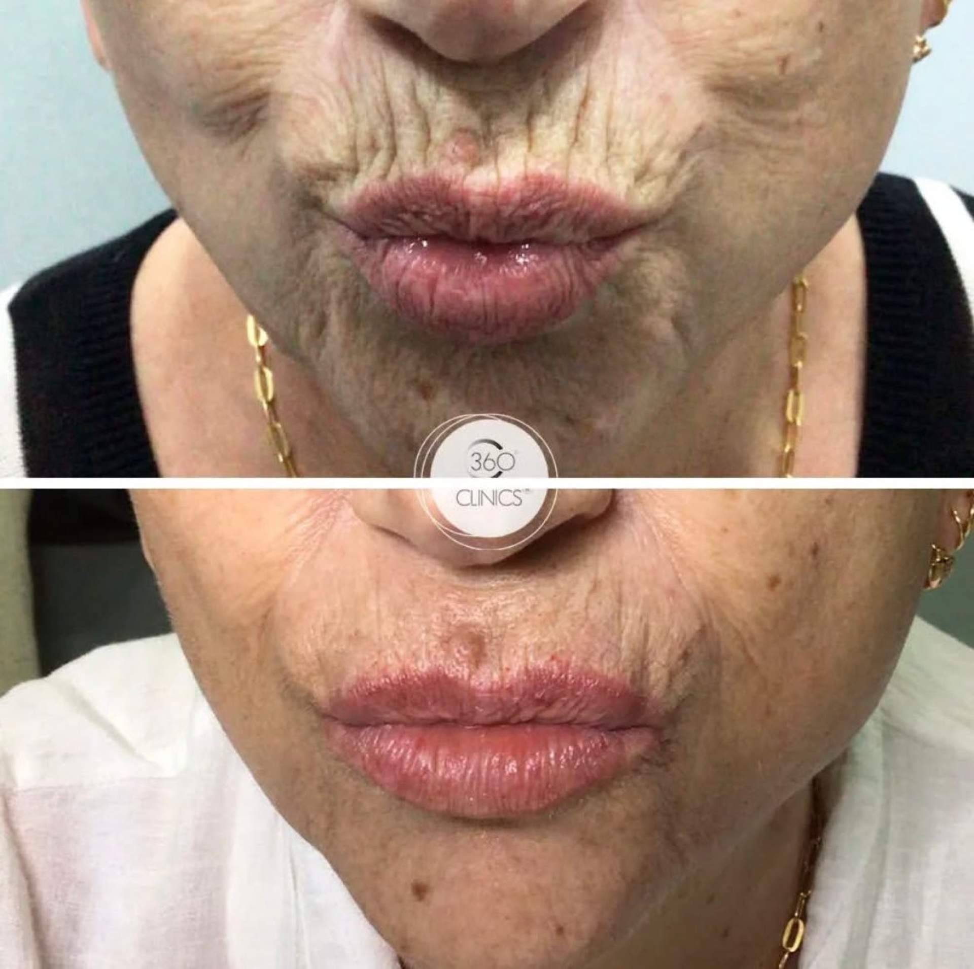 360Clinics explica cómo el ácido hialurónico ayuda a tratar el código de barras y rejuvenecer el labio superior